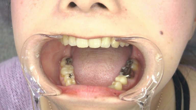 女の子の口内と歯3