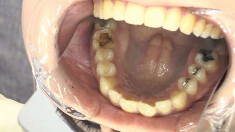 女の子の口内と歯6